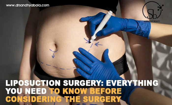 Liposuction Surgery: Everything You Need To Know Before Considering The Surgery