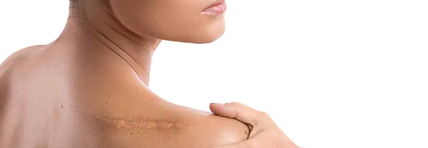 Scar Revision Surgery in Hyderabad, Bangalore