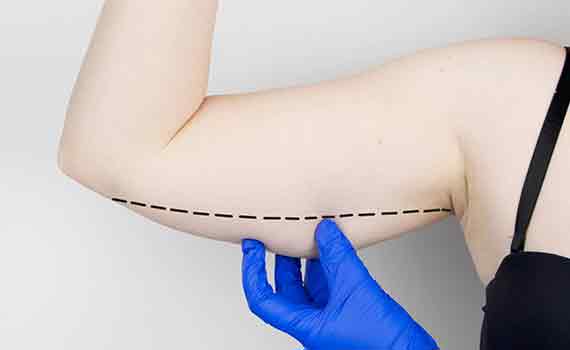 ARM LIFT/ BRACHIOPLASTY HYDERABAD & BANGALORE