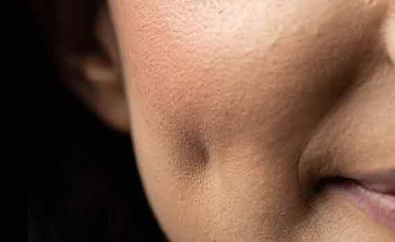 Dimple Creation Surgery in Hyderabad, Bangalore