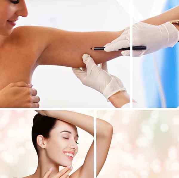 Arm Liposuction Surgery in Bangalore, Hyderabad