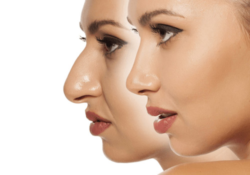 Rhinoplasty Surgery In Hyderabad
