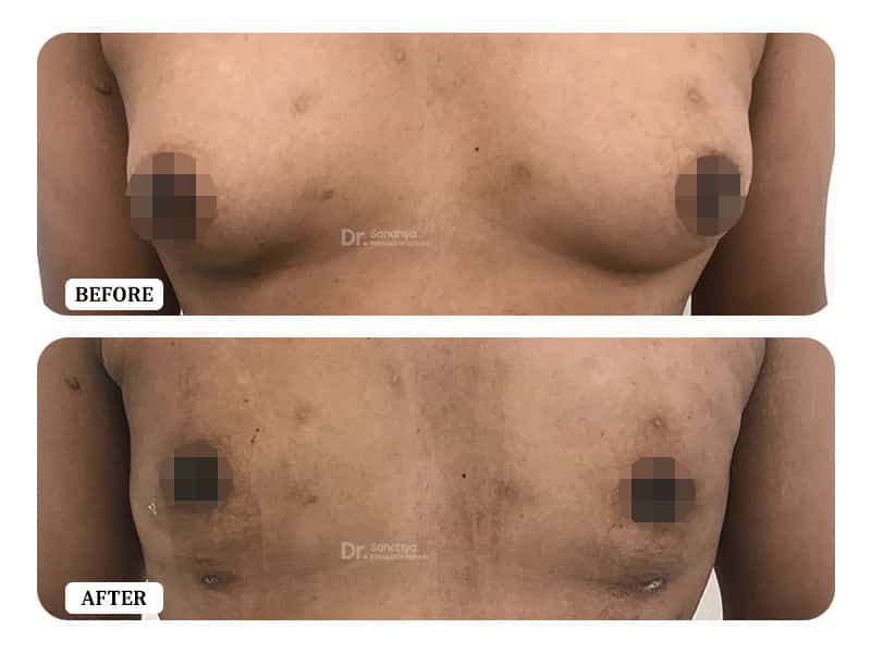 Gynecomastia