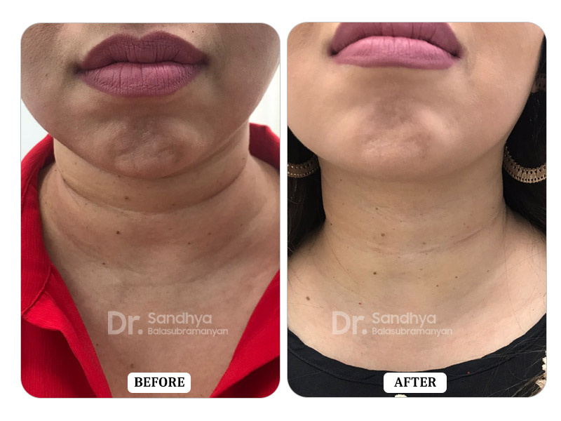 Dermal Fillers