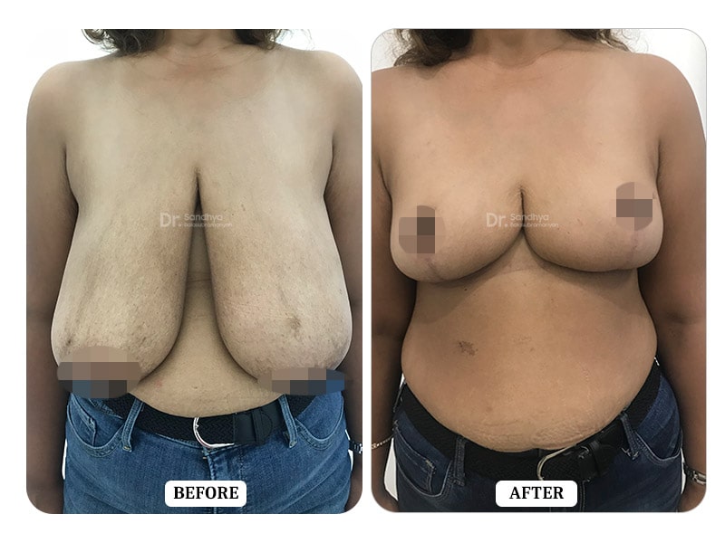 Breast Reduction