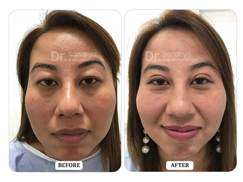 Blepharoplasty