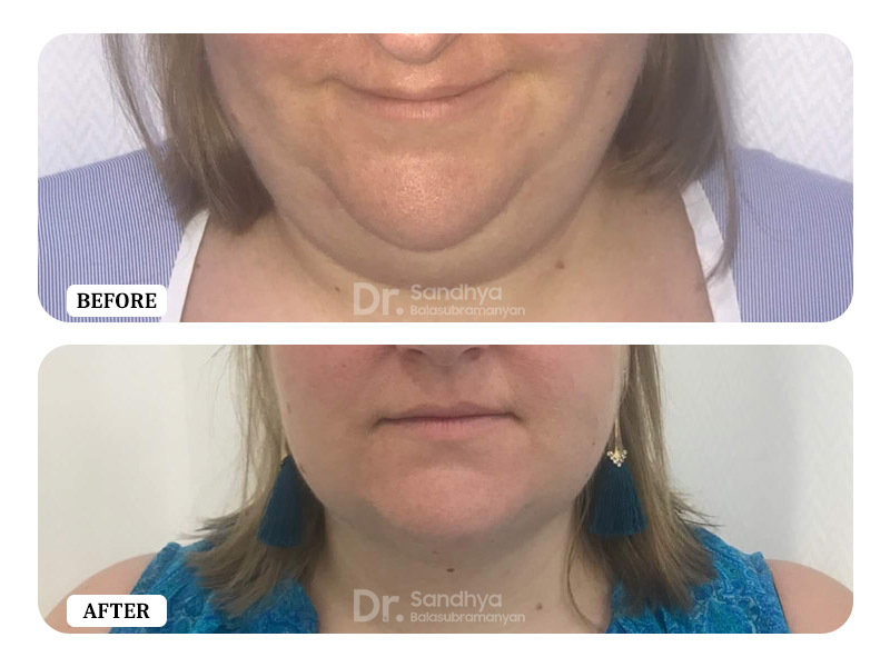 Double Chin Correction
