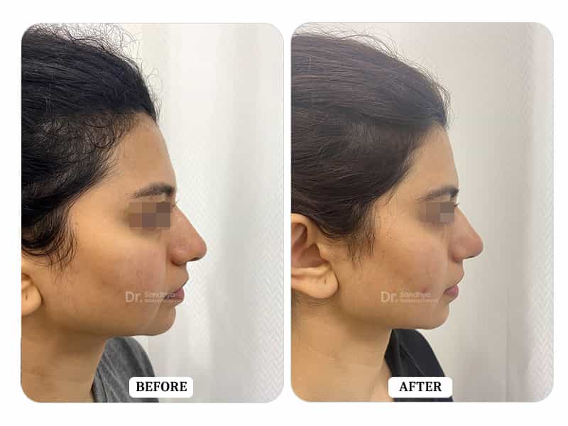 Rhinoplasty