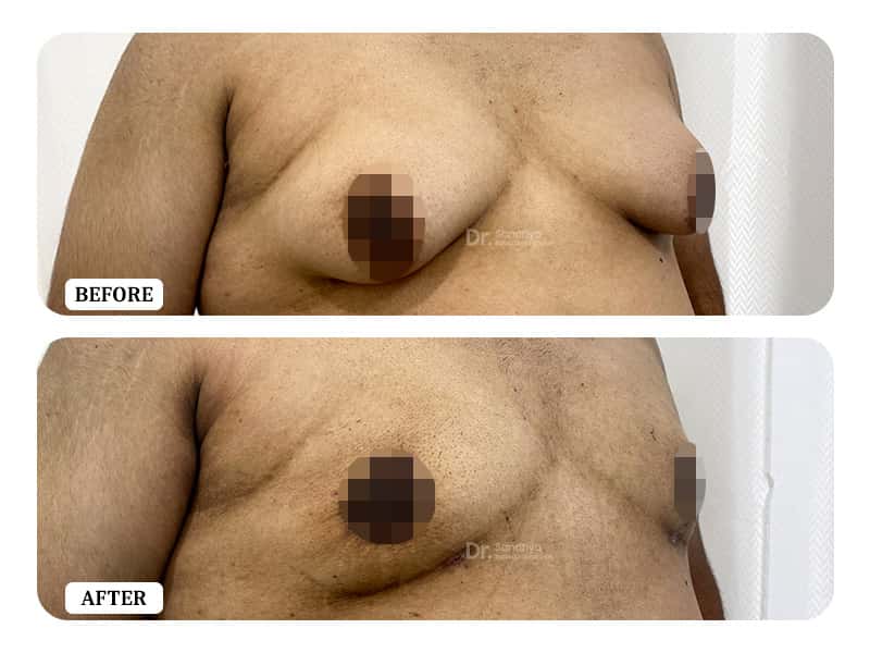 The best plastic surgeon, Dr. Sandhya Balasubramanyan provides the effective gynecomastia surgery in Bangalore.