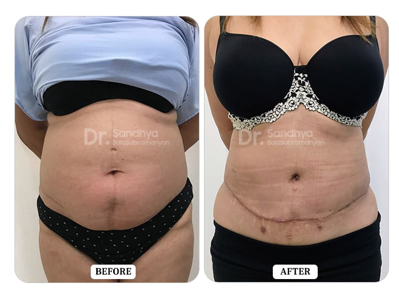 Tummy Tuck Surgery Before and After - Results