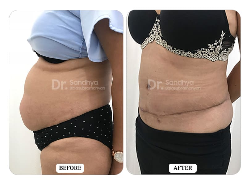 Tummy Tuck Surgery Before and After - Results