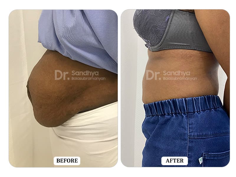 Tummy Tuck Surgery Before and After - Results