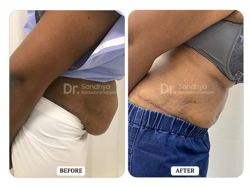 Tummy Tuck Surgery Before and After - Results